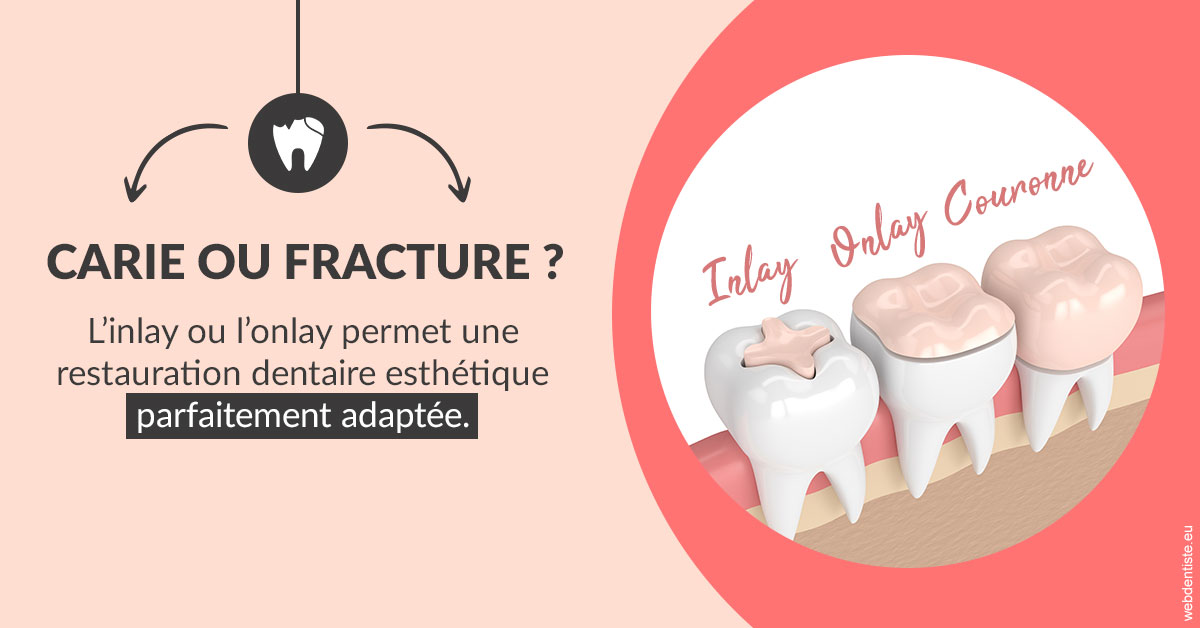 https://dr-azuelos-alain.chirurgiens-dentistes.fr/T2 2023 - Carie ou fracture 2