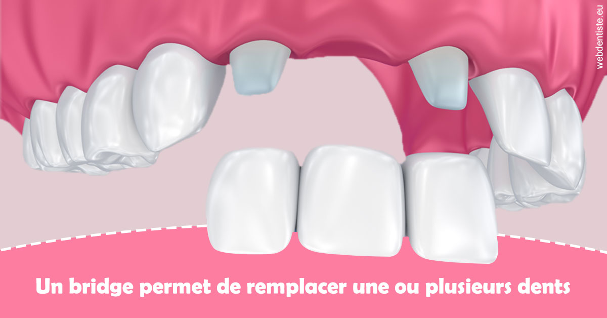 https://dr-azuelos-alain.chirurgiens-dentistes.fr/Bridge remplacer dents 2