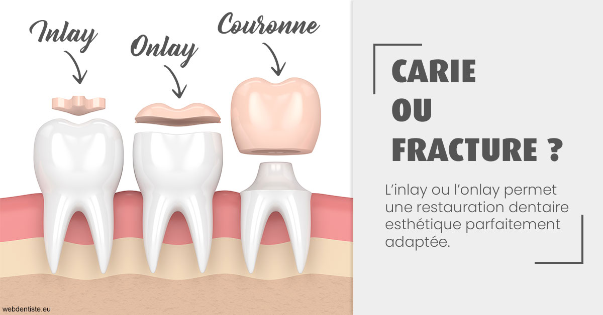 https://dr-azuelos-alain.chirurgiens-dentistes.fr/T2 2023 - Carie ou fracture 1