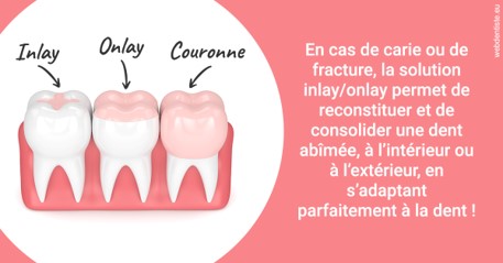 https://dr-azuelos-alain.chirurgiens-dentistes.fr/L'INLAY ou l'ONLAY 2