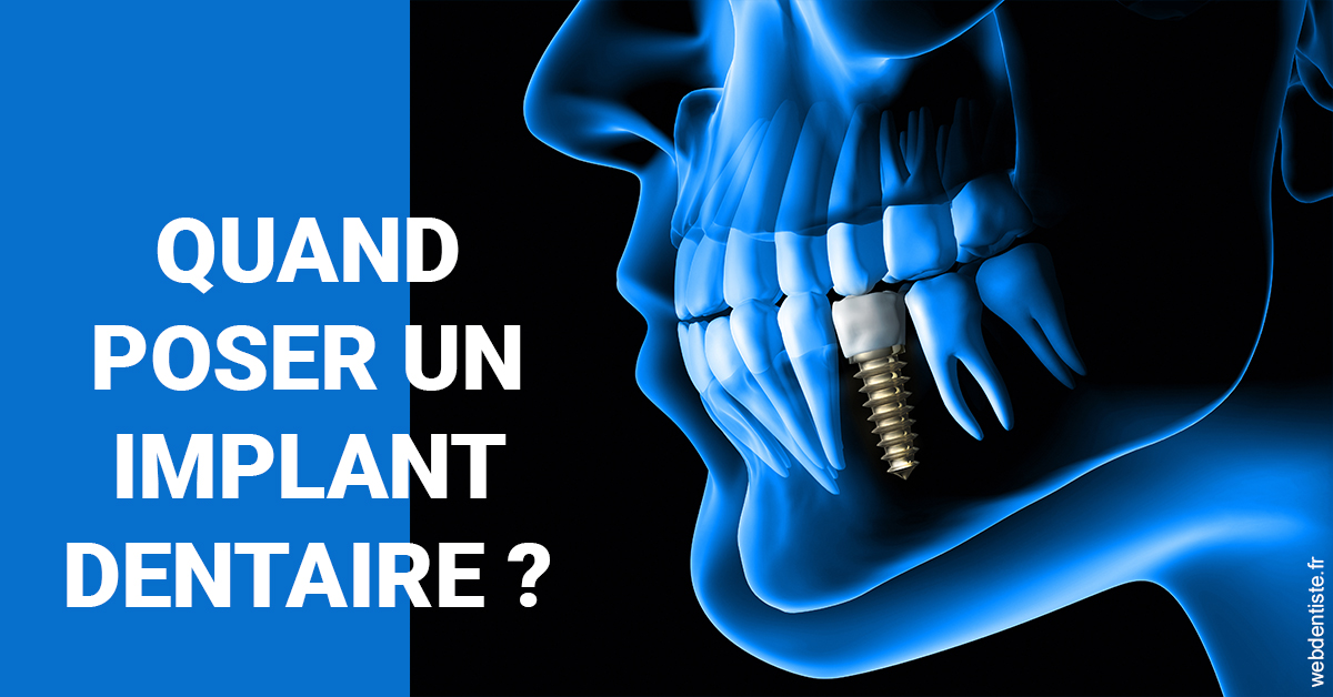 https://dr-azuelos-alain.chirurgiens-dentistes.fr/Les implants 1