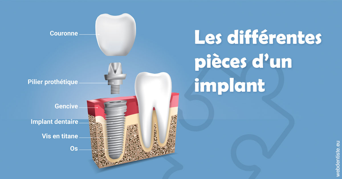https://dr-azuelos-alain.chirurgiens-dentistes.fr/Les différentes pièces d’un implant 1